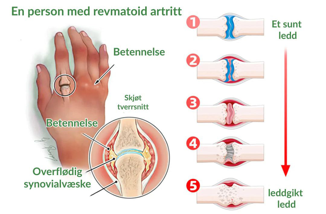 🔥Offisiell butikk: Ourlyard® Chillflex Mint Smertelindrende Krem (Behandling for leddgikt, nervesmerter, revmatiske sykdommer, muskelkramper, rykninger og idrettsskader)