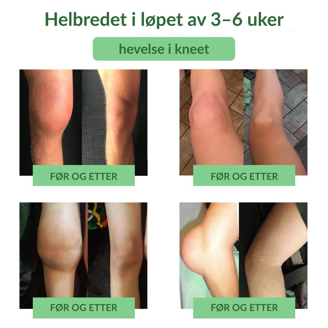🔥Offisiell butikk: Ourlyard® Chillflex Mint Smertelindrende Krem (Behandling for leddgikt, nervesmerter, revmatiske sykdommer, muskelkramper, rykninger og idrettsskader)