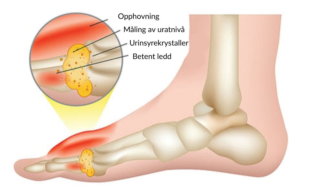🔥Offisiell butikk: Ourlyard® Chillflex Mint Smertelindrende Krem (Behandling for leddgikt, nervesmerter, revmatiske sykdommer, muskelkramper, rykninger og idrettsskader)