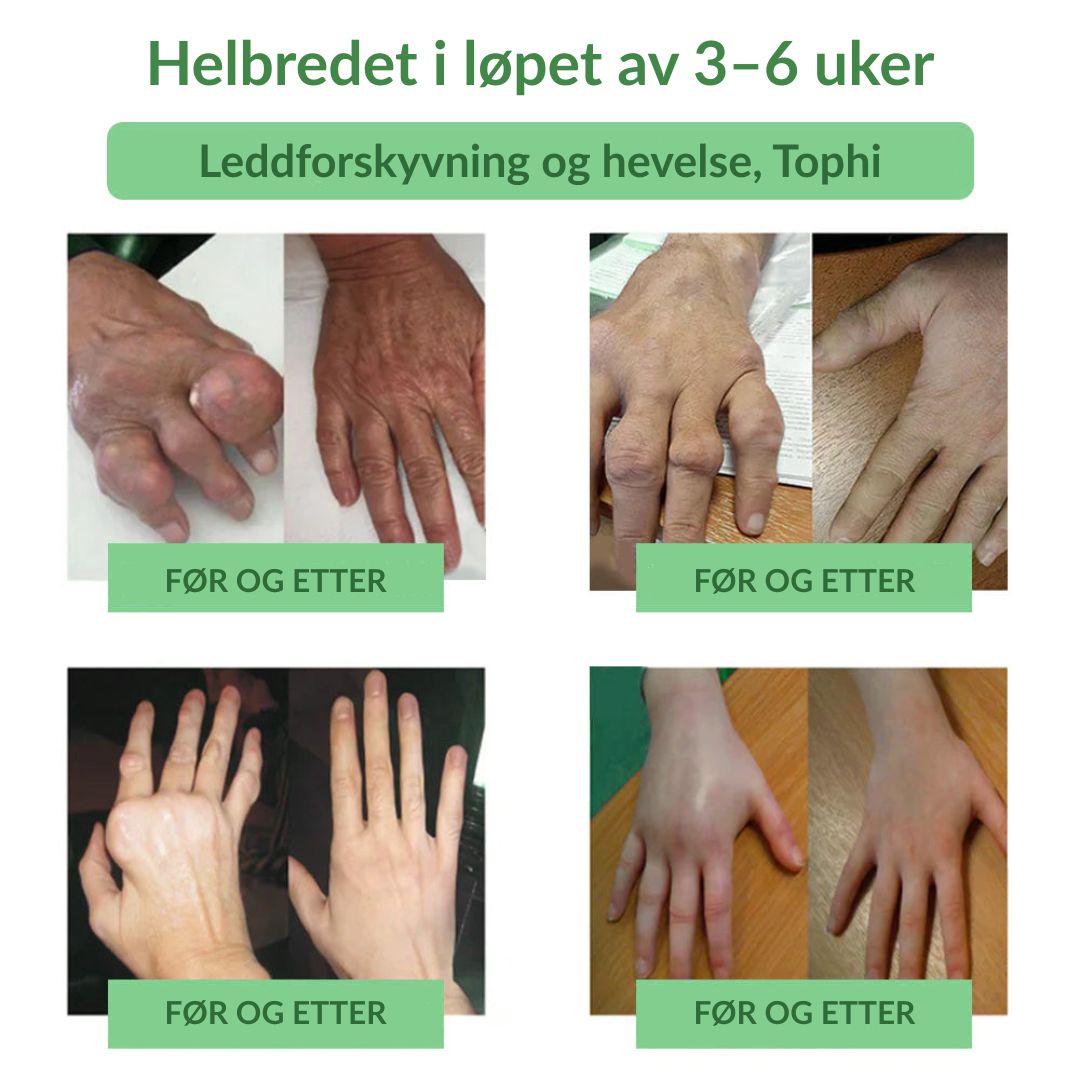 🔥Offisiell butikk: Ourlyard® Chillflex Mint Smertelindrende Krem (Behandling for leddgikt, nervesmerter, revmatiske sykdommer, muskelkramper, rykninger og idrettsskader)